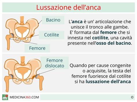 fasciatura per lussazione anca di hermes|Lussazione anca: sintomi, problematiche, terapie e rimedi.